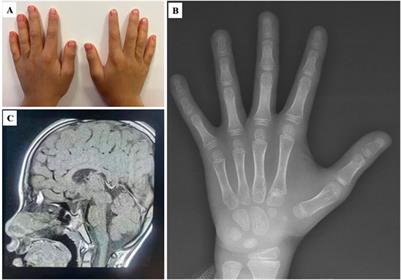 Molecular diagnosis of patients with syndromic short stature identified by trio whole-exome sequencing